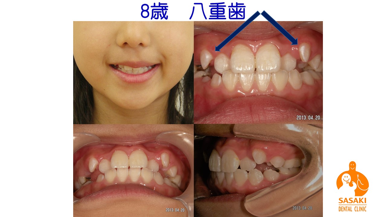 小学生・永久歯が八重歯になった場合の矯正治療