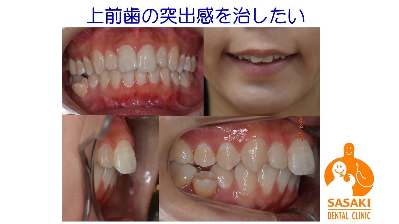 比較的重度の歯列不正でも永久歯を抜かずに治した２例