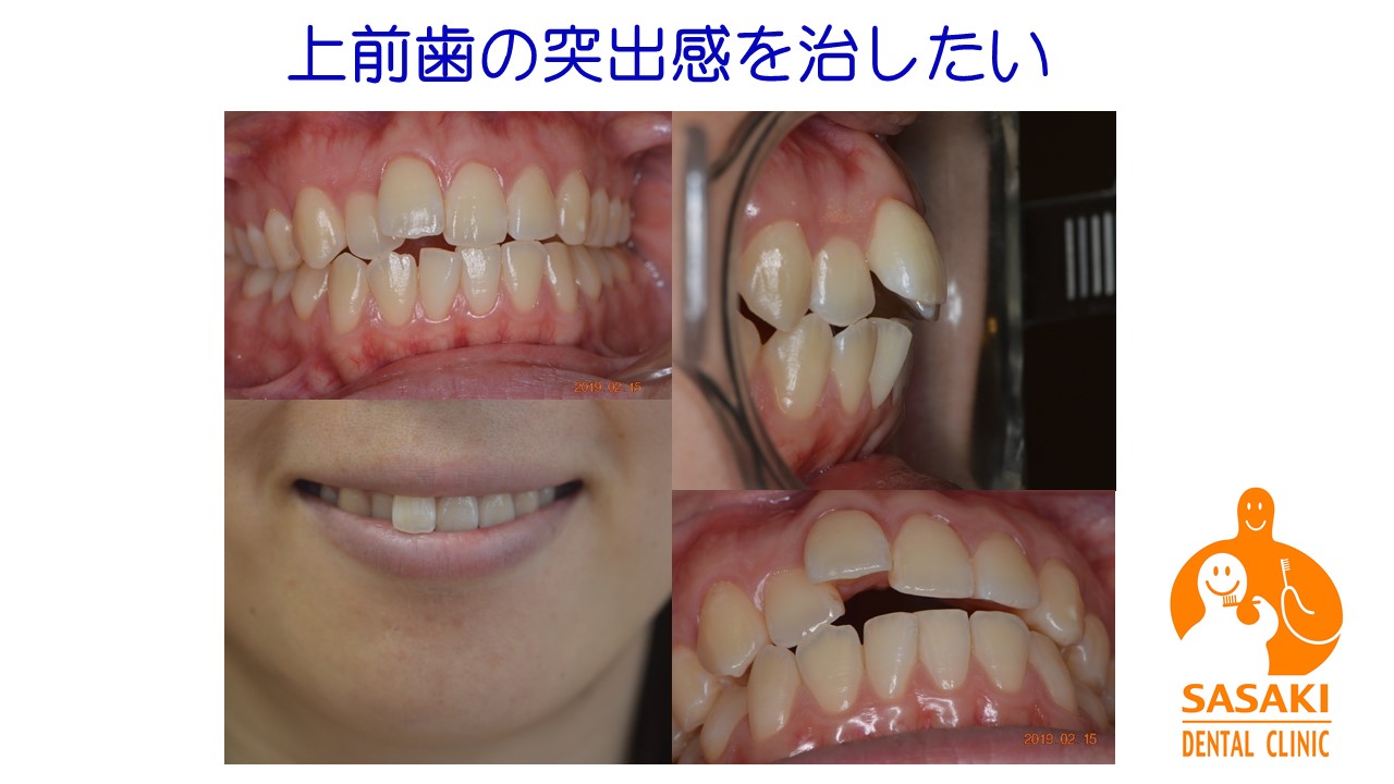 上前歯の突出を１０か月程で改善した20代女性の笑顔