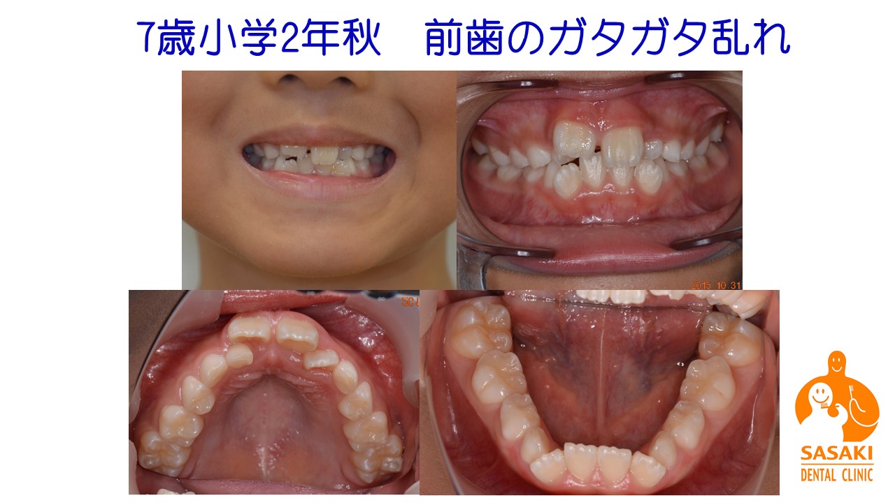 なぜ佐々木歯科の小児矯正は針金を使用せず、顎を大きくするか
