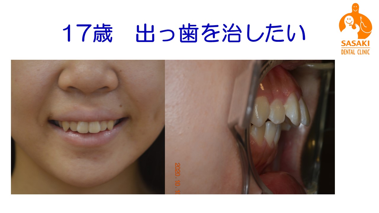出っ歯・受け口・八重歯　歯を抜かない矯正治療で綺麗になります　令和４年